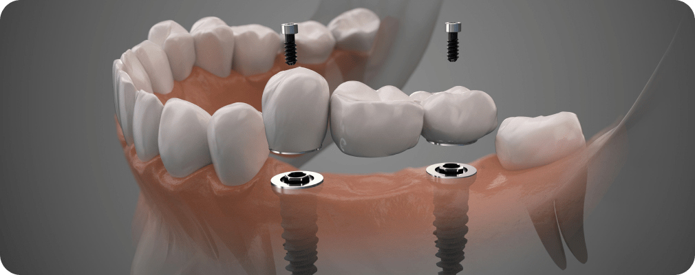 Docteur Stéphane Beal, Dentiste Vincennes 94300 implants dentaires