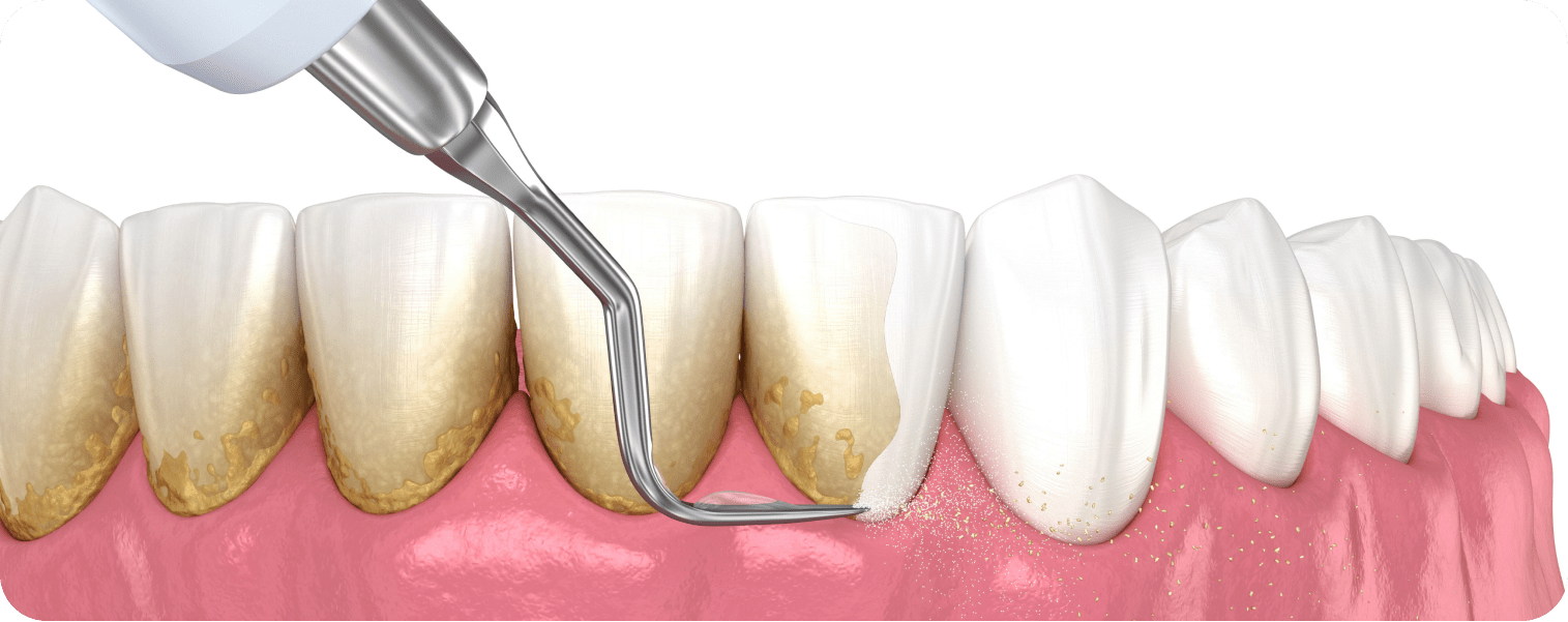 Dentiste Vincennes 94300 soin de gencives