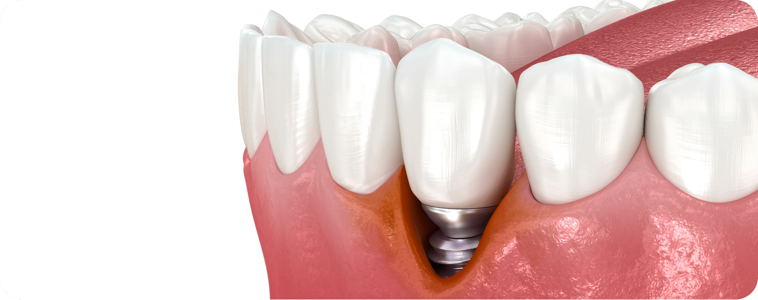 Dentiste Vincennes 94300 implant dentaire