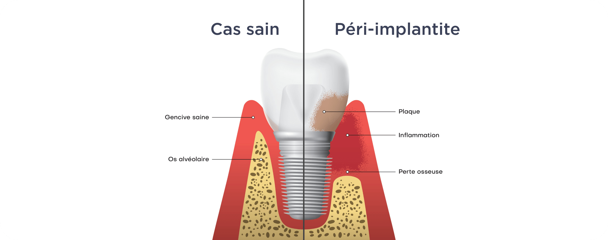 Dentiste Vincennes 94300 implant dentaire