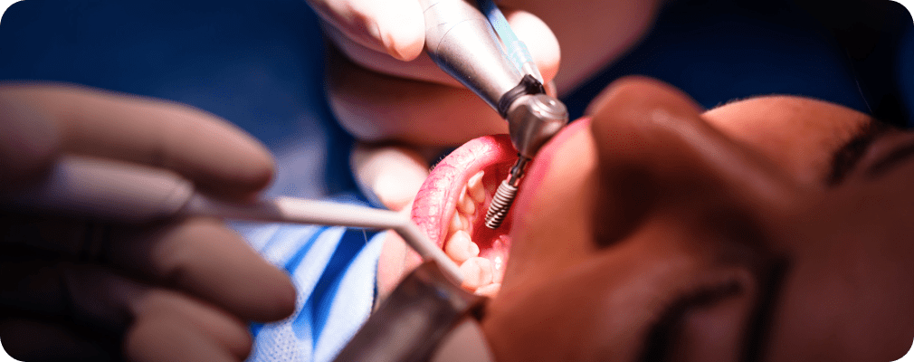 Dentiste Vincennes 94300 implant dentaire