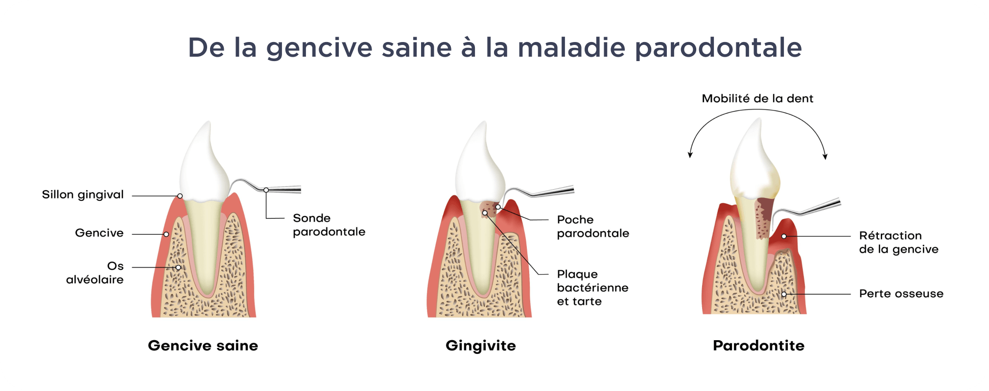Dentistes Vincennes 94300, soin de gencives