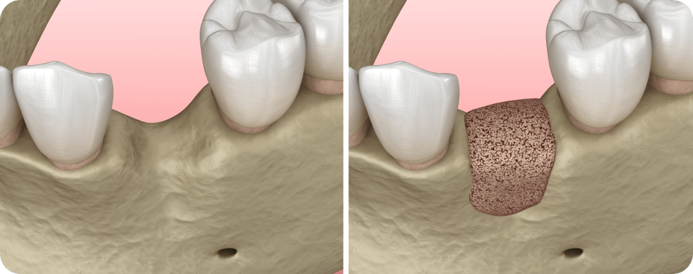 Greffes osseuses Dentiste Vincennes 94300