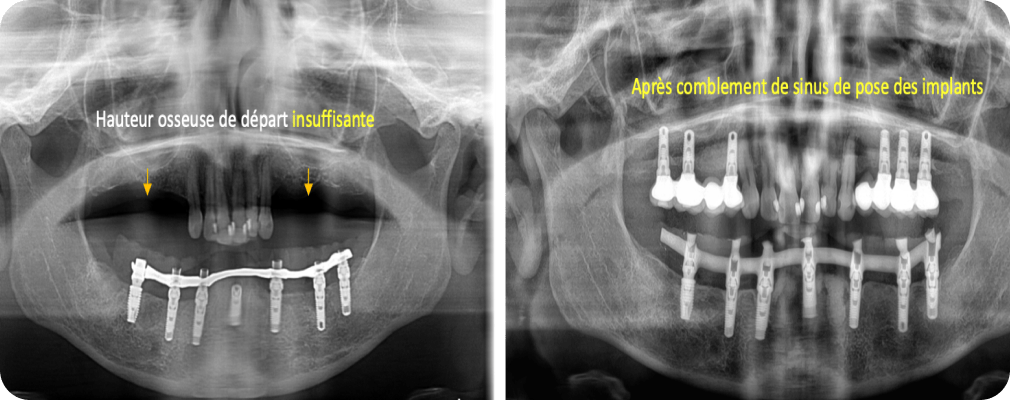 Dentiste Vincennes 94300 implant dentaire