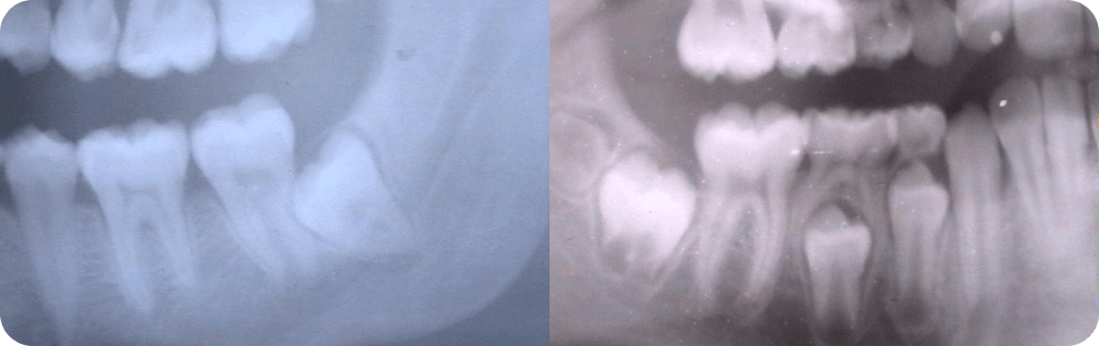 Dentiste Vincennes 94300 dents et canines incluses