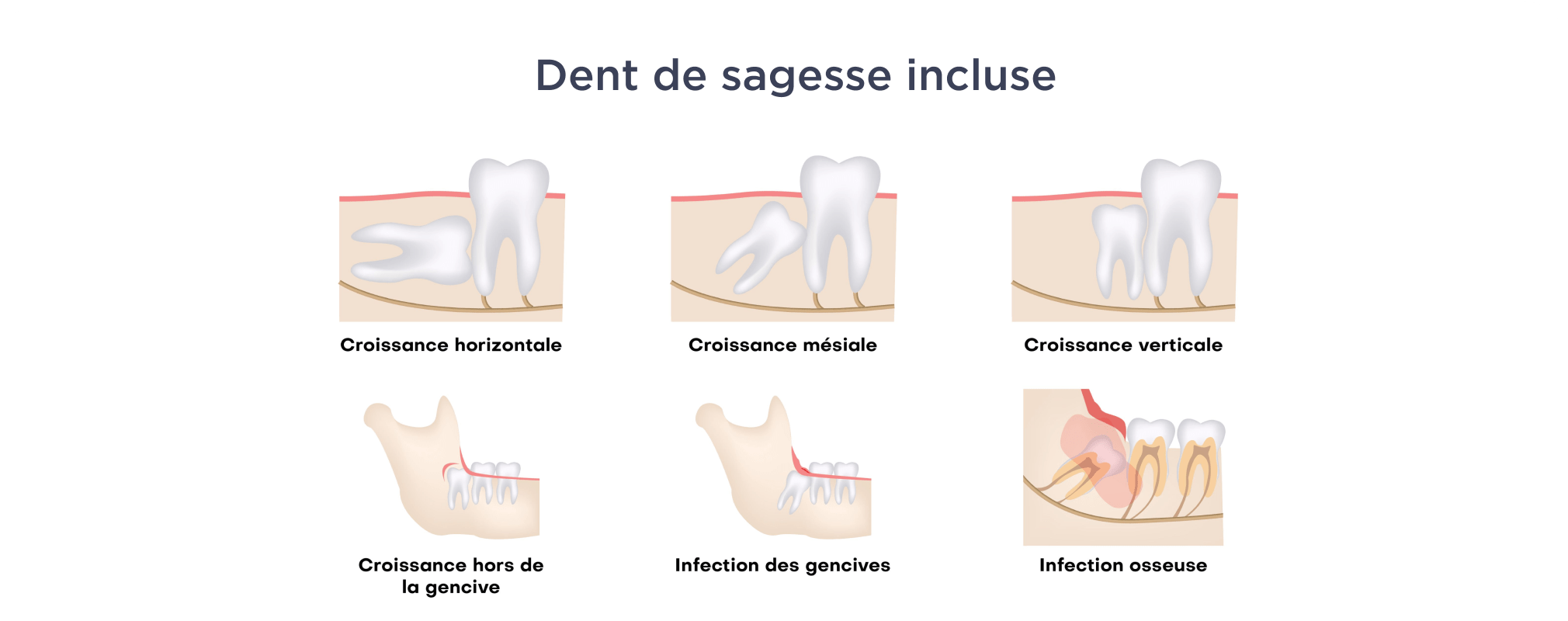 Extraction de dents de sagesse Dentiste Vincennes 94300