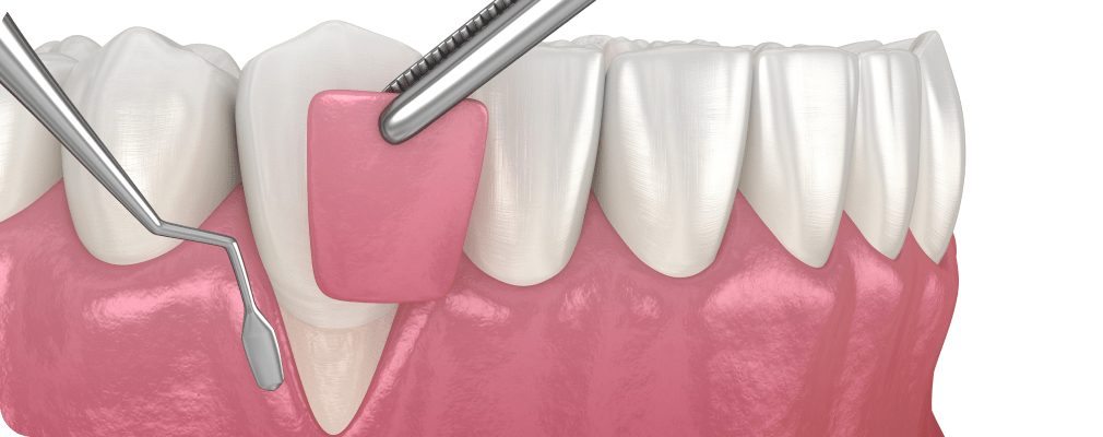 Dentiste Vincennes 94300, Greffe de gencive
