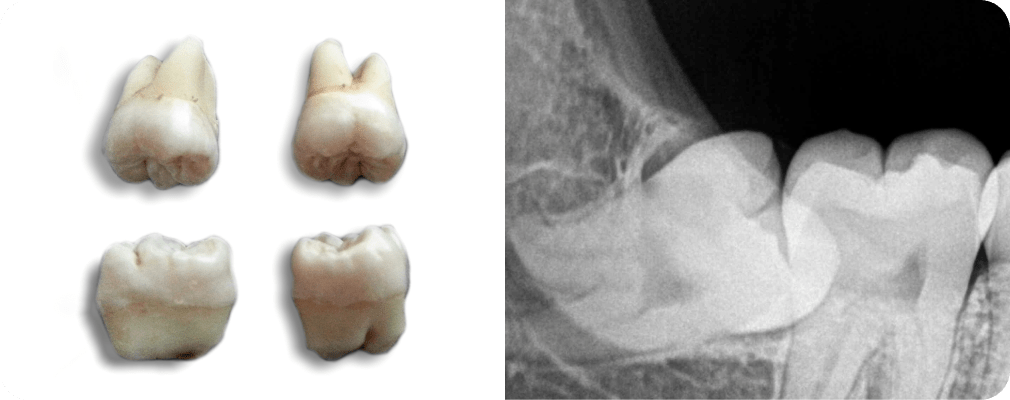 Extraction de dents de sagesse Dentiste Vincennes 94300