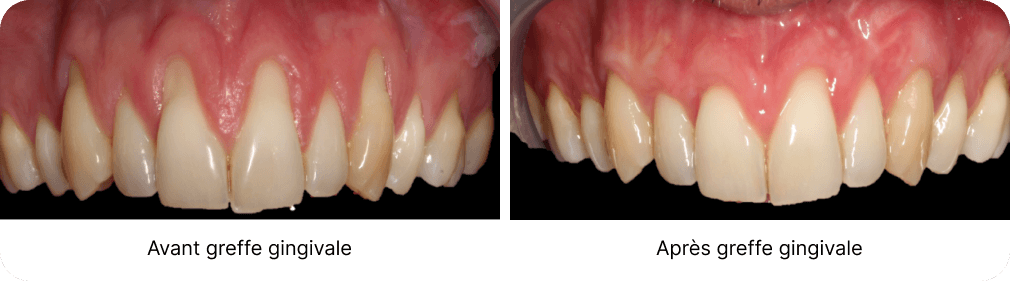 Greffe de gencive, Dentiste Vincennes 94300
