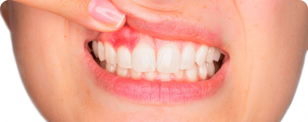 Dentiste Vincennes 94300 soin de gencives