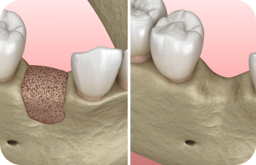 Docteur Beal soins des gencives à Vincennes. J’ai perdu de l’os autour des dents, est-il possible d’en ajouter chirurgicalement ?