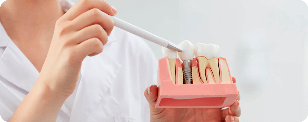 implant dentaire Dentiste Vincennes 94300