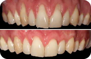 Titane, Drs Kruk & Beal: problèmes de gencives. Pourquoi ai-je les dents qui sont trop longues ? Ma gencive a disparu !