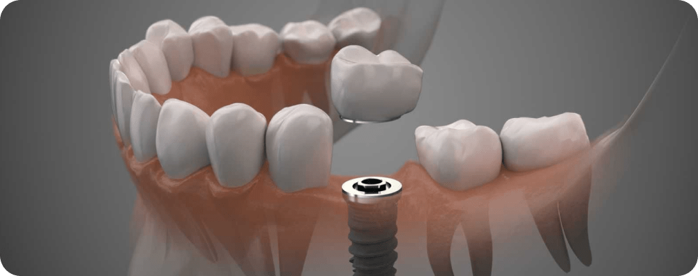 Dentiste Vincennes 94300 implant dentaire