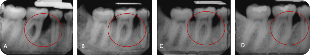 Dentistes Vincennes 94300 Traitement parodontal chirurgical