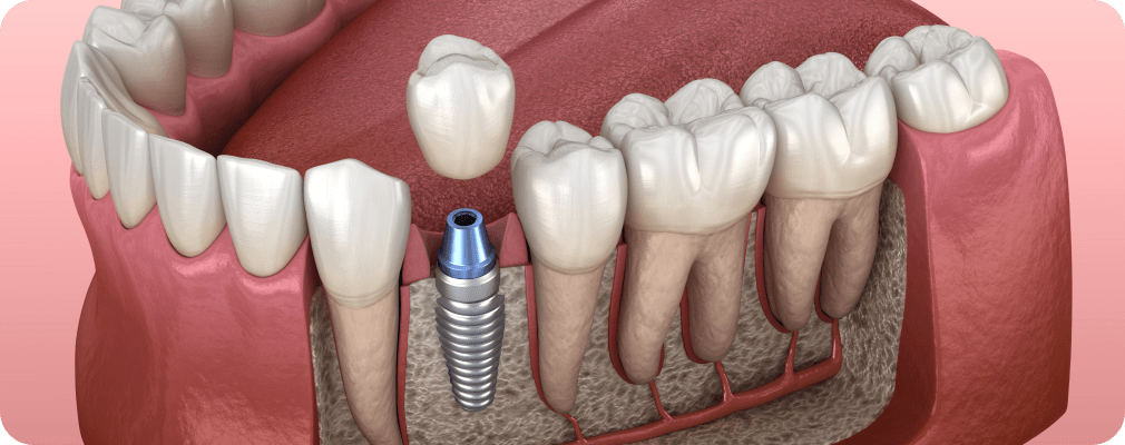 Dentiste Vincennes 94300 implant dentaire